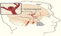 درمان آنوریسم مغزی به روش کوییلینگ اندوواسکولار توسط دپارتمان اینترونشن مغزی صورت گرفت .